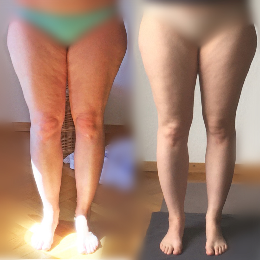 Vorher Nachher Cellulitefrei light – Cellulite reduziert, Lipödem sichtbar verbessert ohne OP